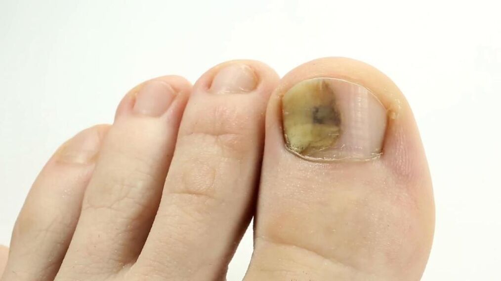 The appearance of a toenail affected by fungus
